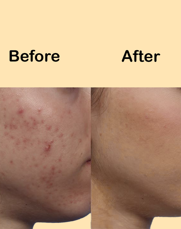 Acnivé – Advanced Anti-Acne & Blemish Control Serum